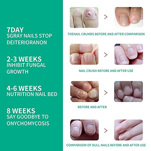 4Pcs Kerassentials Toenail Treatment Oil, Natural Toenail Treatment Oil For Nails, Kerasentials Nail Treatment, Extra Strength For Repairing #TOP2