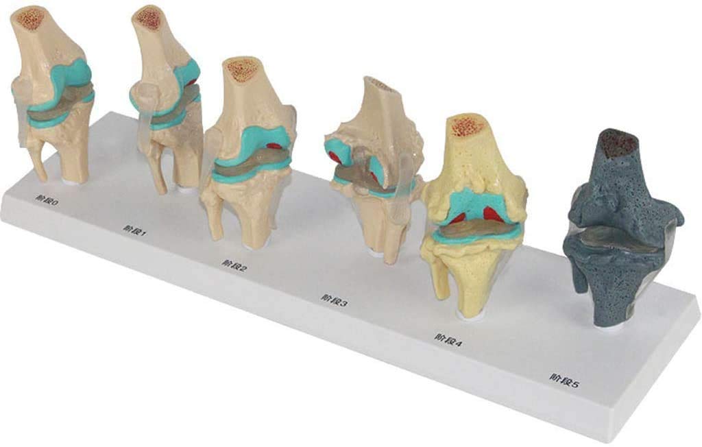 Modèle de blessure au Genou en 6 étapes - Le Genou modèle Anatomique Joint - Affichage de la Science de l'étude en Classe avec des modèles de Rubans et de matériel médical