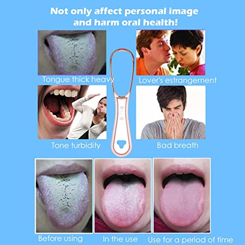 Xiahium Tongue Scraper For Adults Fresh Breath Tongue Cleaner Reusable Fight Bad Breath Healthy Oral Care For Adults Kids - 100% Bpa Free #TOP3