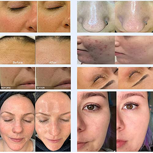 7 In 1 Oxygen Facial Hydra Dermabrasion Beauty Skin Management System Smart Ice Blue Facial Machine (2-5Days Delivery) #TOP3