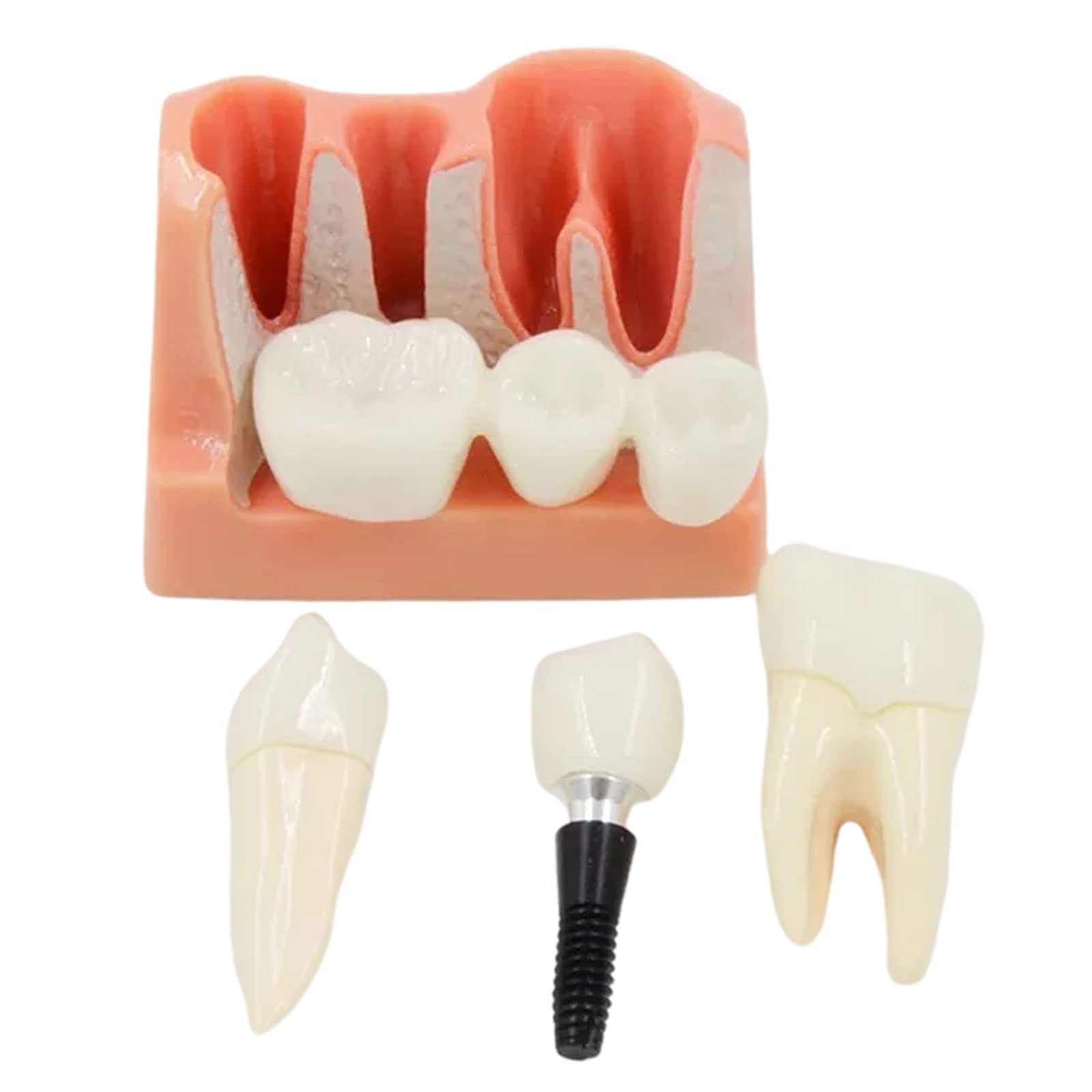 Amovible Modèle D'implant, Modèle Dentaire de Pont de Couronne, Modèle de Dent pour Aidant Le Dentiste et Le Patient à Communiquer et à Discuter du Plan de Traitement, Intuitif et Portable