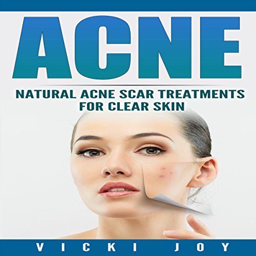 Acne Natural Acne Scar Treatments for Clear Skin (Audio Download