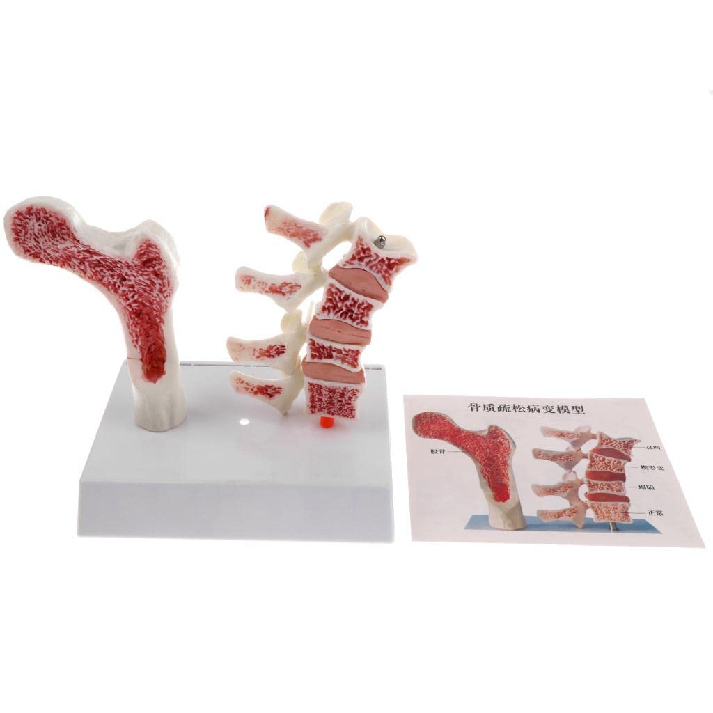 predolo 1: 1 Modellbausatz für Die Osteoporose des Menschlichen