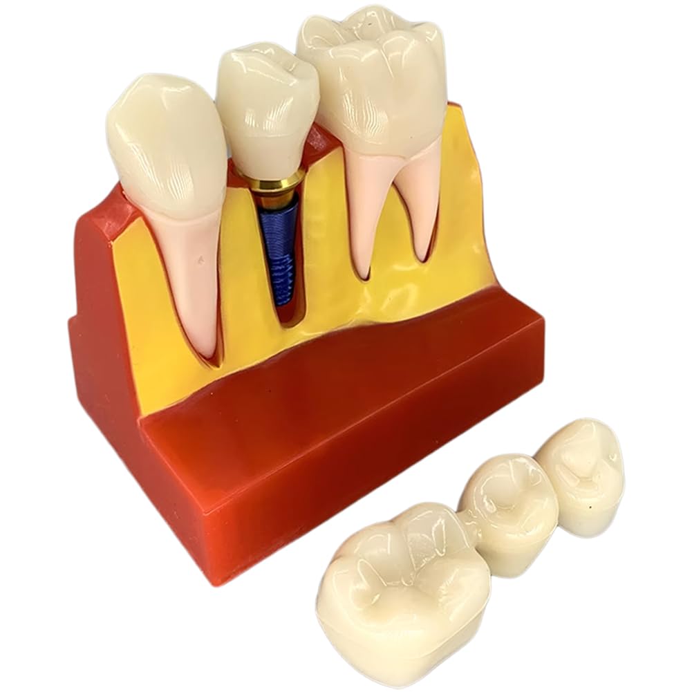 Modèle D'implant Dentaire - Modèle De Dent De Démonstration Pour Couronne Bridge Amovibles (4 Fois) - Modèle De Dent Pour L'analyse D'implants Dentaires À Des Fins D'apprentissage De Formation