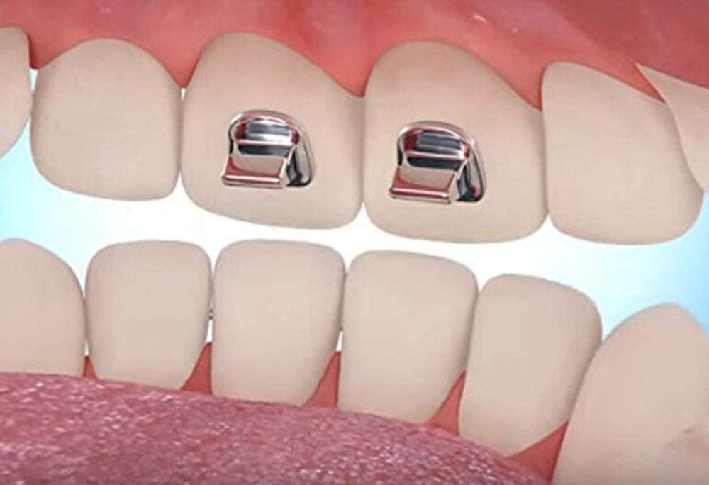 Tubo De Ortodoncia, 200 Piezas, Tubo Oral, First M | Meses Sin Interés