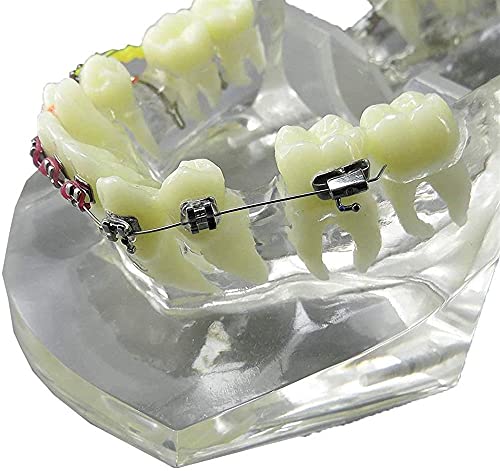 Modèle dentaire malocclusion pour expliquer le traitement aux patients