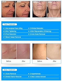 R A Products™ 2 in 1 Micro Needling Needle Microneedle Face Lift Acne Scar Removal Non-invasive Super Facial Fractional RF Microneedling Machine