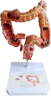 ZBCKKING 3D Human Organ Model,1:1 Life Size Colon Lesion Anatomical Model Digestive System Large Intestine Teaching Model Colorectal Disease Demonstration Tool for Medical Education