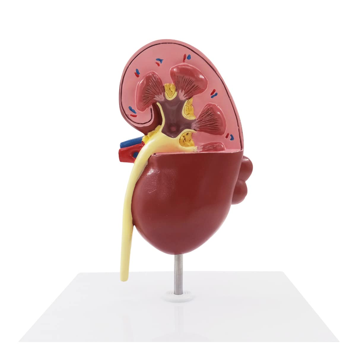 Pathologisches Modell, menschliches Nierenläsionsmodell, Anatomie, pathologisches Steinorgan, Nierensteine, Urologie, Nierenmodell für medizinische Lehr-/Bildungsbedarf