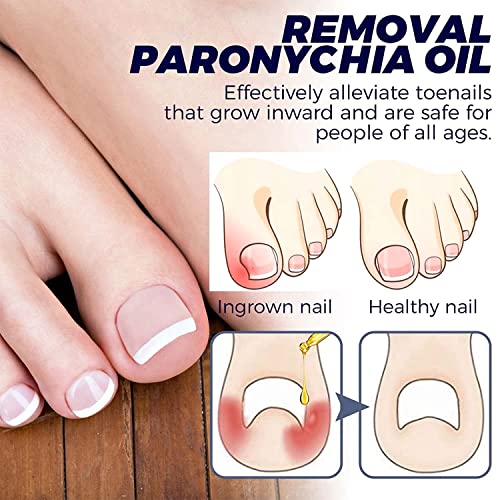 4Pcs German Toenail Nail Solution #TOP7