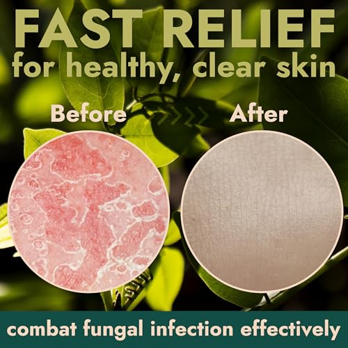 Image of Antifungal Soap Medicated Jock Itch Treatment with Tea Tree Oil 2 Pack | Medicated Jock Itch Treatment, Fights Ringworm & Athlete's Foot, Soothing Tea Tree & Eucalyptus, Effective Relief, Soap Case