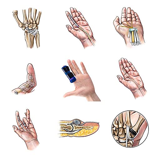 Quanquer Trigger Finger Splint, Mallet Finger Brace, Finger Knuckle Immobilization For Index, Middle,Ring Finger-Tendon Release Pain Relief Broken Finger… #TOP6
