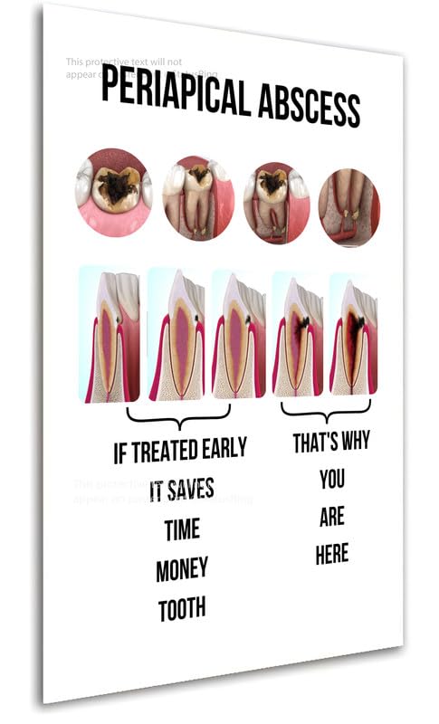Caries to periapical abscess Dentist dental clinic poster StatusRing without frame-picture-18