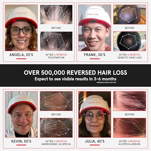 iRestore Professional Laser Red Light Therapy for Hair Growth System - FDA Cleared Hair Loss, Hair Thinning & Alopecia Treatment for Men & Women - 282 Lasers & LEDs - Thumbnail 2
