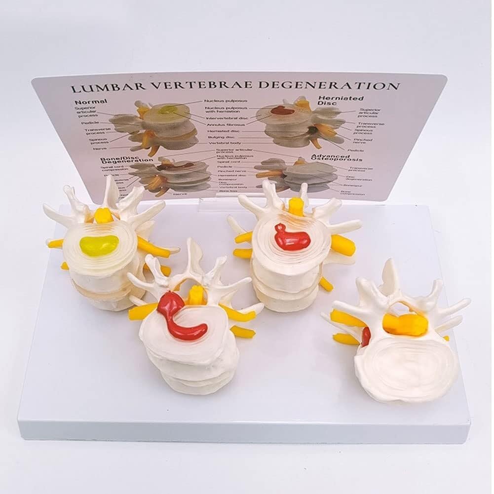 Modello di Vertebre a 4 Stadi, Modello di Ernia del Disco Intervertebrale di Scheletro Umano, Modello di Colonna Lombare Patologica, con Scheda Posteriore Inglese, per Studio Medico E Aule
