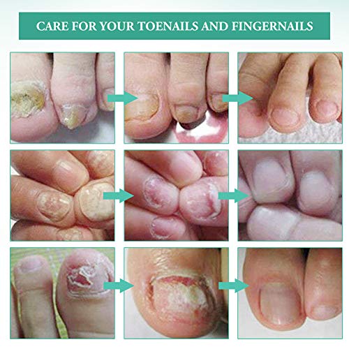 Nail Fungus Cream,Toenail Fungus Treatment,Nail Fungus Remover,Toenail Fingernail Fungus Remover Fungus Stop Cream