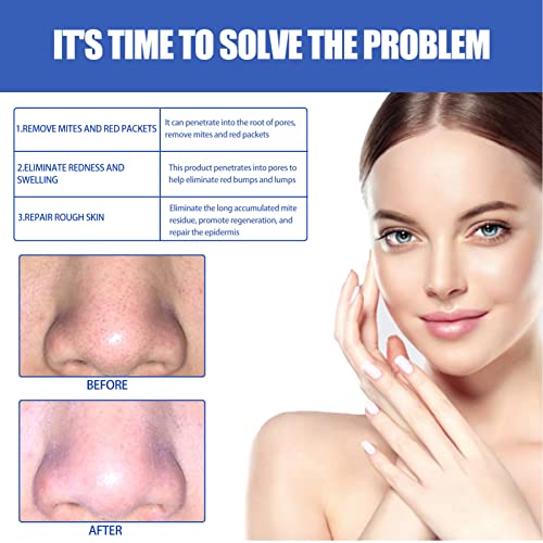 Rosacea Relief Fluid, Nasal Care Rosacea Treatment Liquid For Home #TOP3