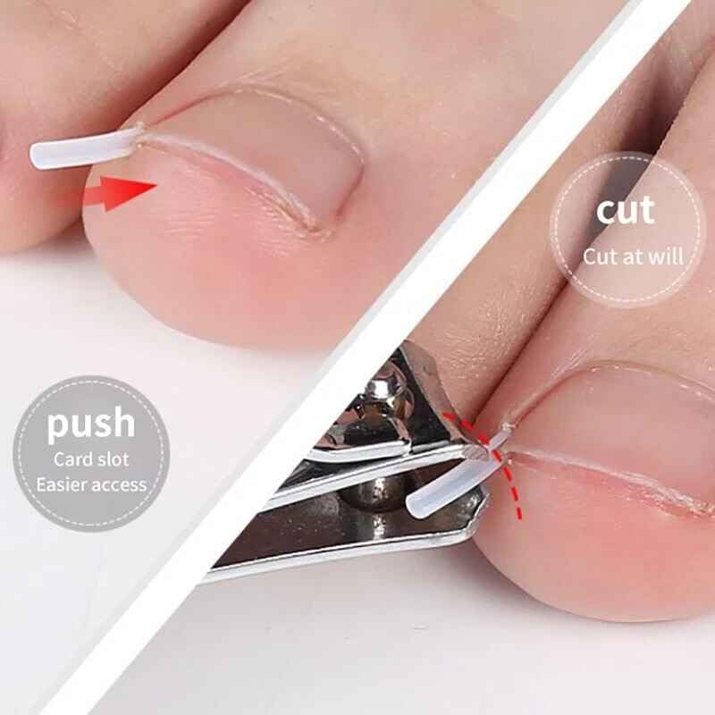 20Pcs Ingrown Toenail Correction Strips Brace Kit,Ingrown Toenail Corrector Straightener Strips Recover Clips Toenails Thick Pedicure Tool Toenail Straightener Strip