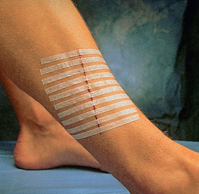 Steri-Strip Wound Closure 3 x 75 mm (12 x 5 Pieces)