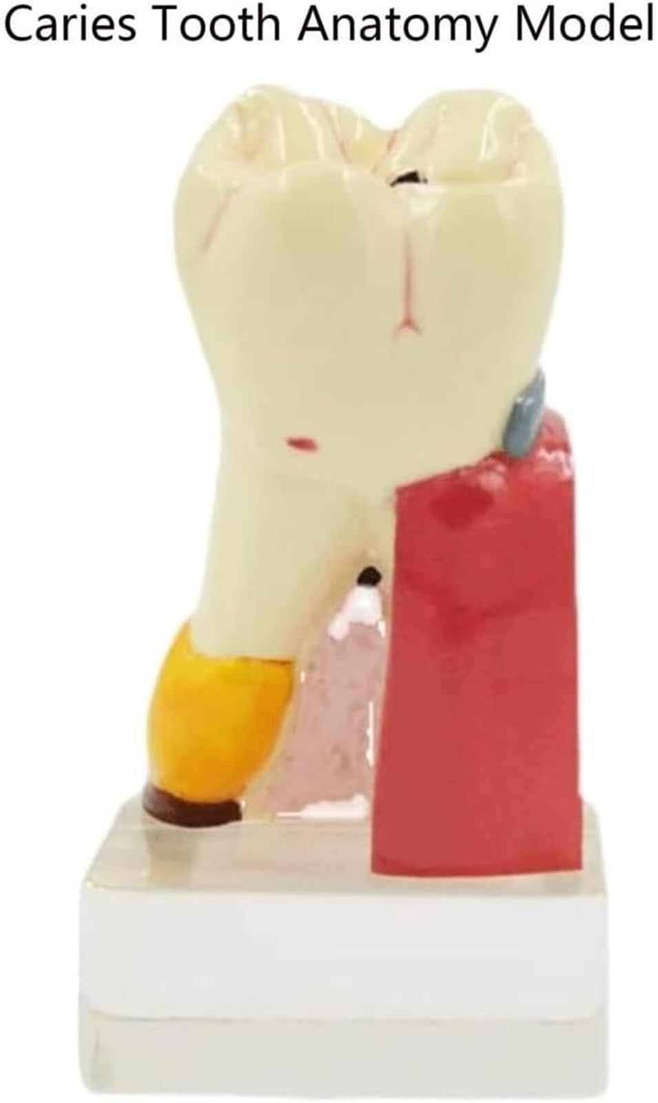 4X powiększony model anatomiczny próchnicy zębów z antypoślizgową podstawą - Dentystyczne narzędzie edukacyjne do demonstracji postępu próchnicy i struktury zęba