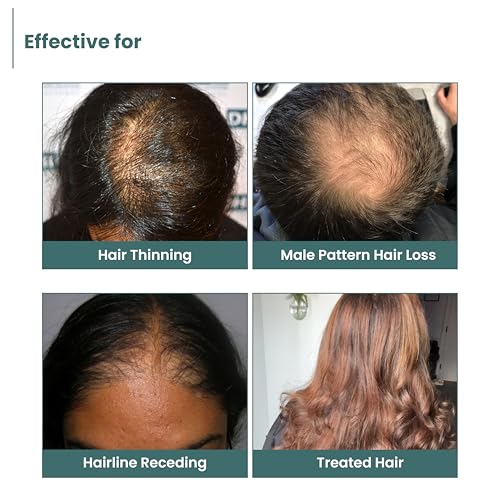 Image of Anable Hair Regrowth Serum- 3% Redensyl, 3% Procapil, 2% Anagain | Hair re-growth & hairfall control serum for man & woman| Clinically tested and safe