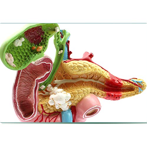 Modèle anatomique du pancréas pour expliquer les pathologies aux patients - 5