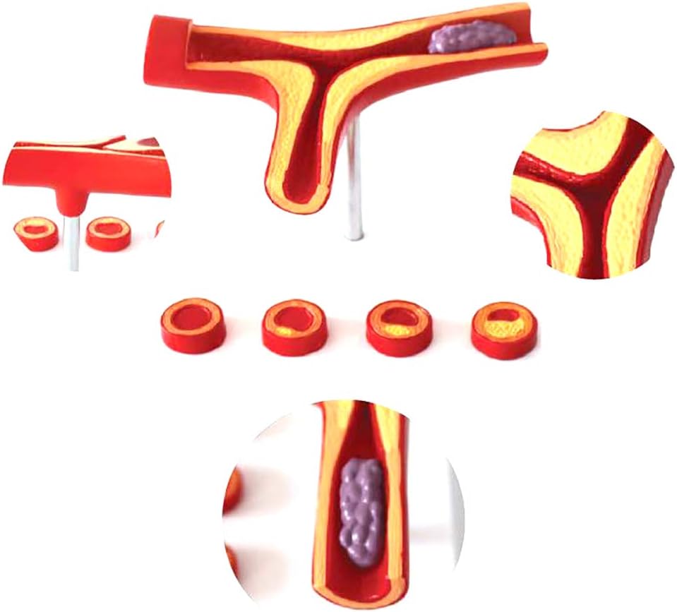 Teaching Model,Human Blood Vessel Anatomical Model, Human Y-Vessel Model Cardiovascular Atherosclerosis Model, Thbosis Demonstration, Arteriosclerosis Model