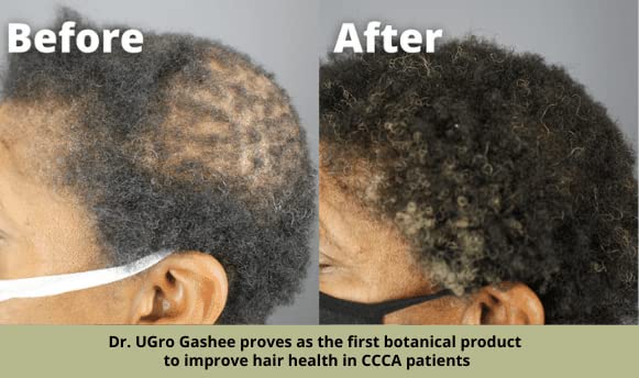 Miniatura 2 de Dr.UGro Gashee Suplemento para el crecimiento del cabello para hombres y mujeres vitaminas para el cabello más grueso y fuerte. Promueve el