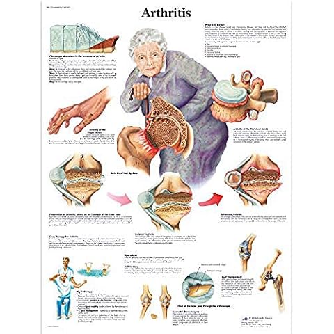 3B Scientific Lehrtaffel - Arthritis Chart - Englisch Cover
