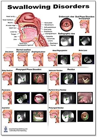 Blue Tree Publishing Swallow Disorders Anatomy Poster 12x17inch, Dysphagia Endoscopic View-oral Phase Disorders-nasal Regurgitation
