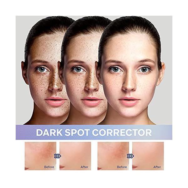 Dark-Spot-Remover-Dark-Spot-Corrector-Remover-for-Face-and-Body-Dark-Spot-Remover-with-Natural-Ingredients10-Fl-Oz REJOPES Dark Spot Remover, Dark Spot Corrector Remover for Face and Body, Dark Spot Remover with Natural Ingredients,1.0 Fl Oz, White, 1 Fl Oz (Pack of 1)