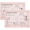 Regla de ECG, regla de ECG de 2 piezas con la interpretación de ECG/ECG de 7 pasos, herramienta de medición de ECG transparente, siga el plan en 7 pasos, para los estudiantes, el personal médico, 8,6