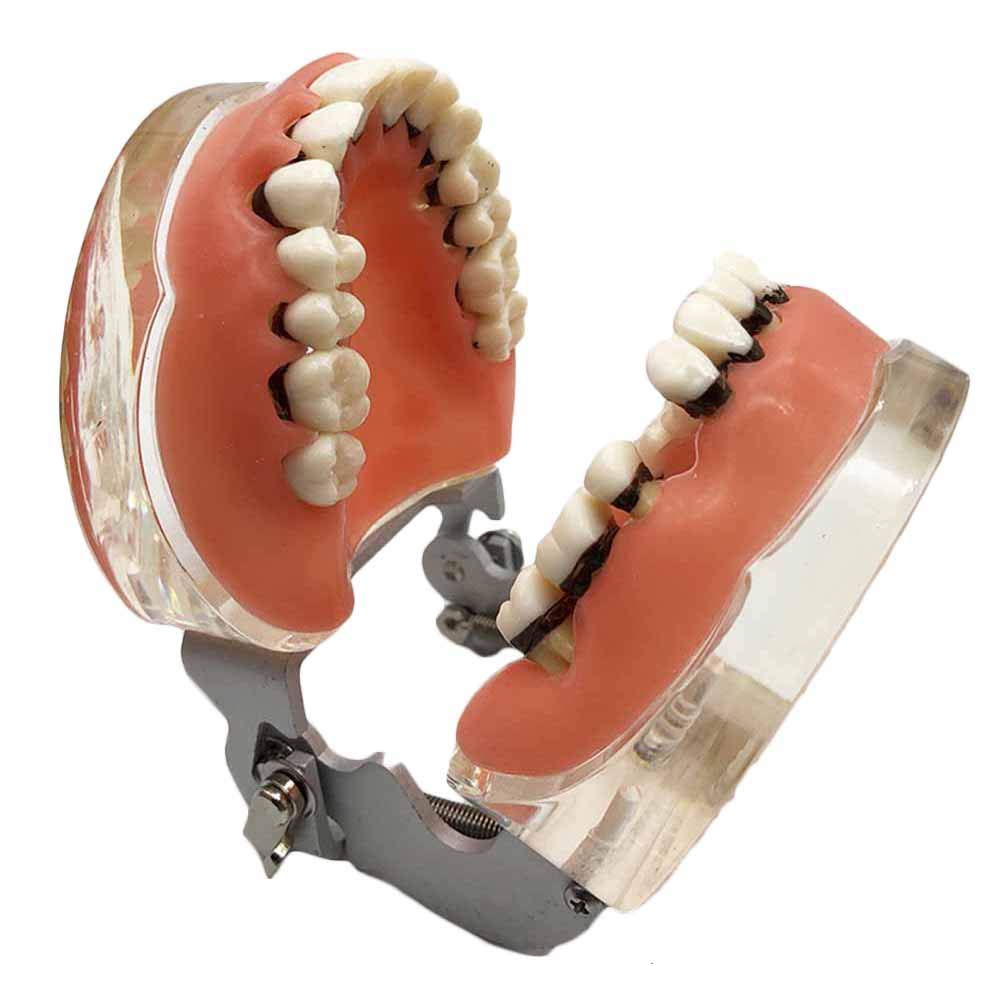 Sjdopulse A Dental Teeth Study Teaching Model - Transparent Dult Pathological Periodontal Disease Teeth Model - Teeth Demonstration Model With Gum - Teeth Model For Education (A)