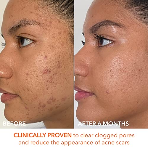 Dr. Dennis Gross Alpha Beta Extra Strength Daily Peel: For Oily Skin, Uneven Tone Or Texture, Wrinkles Or Enlarged Pores (60 Treatments) #TOP7