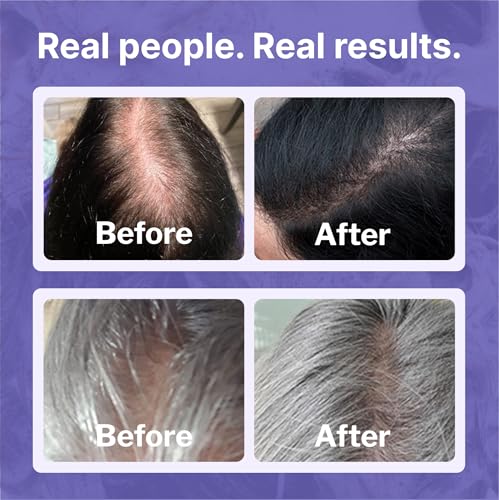 Shapiro MD Hair Growth Experts Minoxidil 2% Topical Solution for Women, Serum Promotes Hair Regrowth by Reactivating Hair Follicles (1 Month)