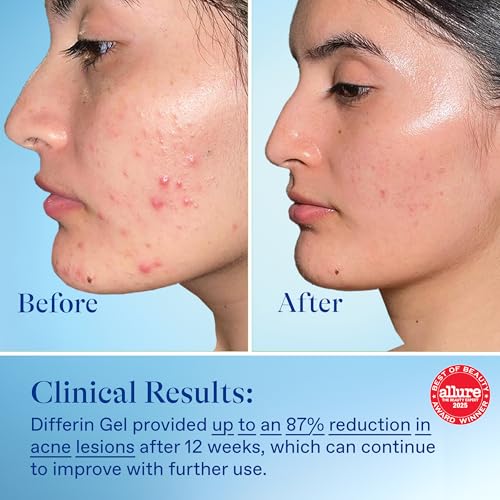 image for Differin Acne Treatment Gel, 60 Day Supply, Retinoid Treatment for Fac