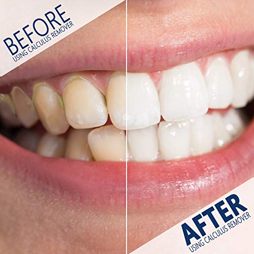 Tartar, Plaque Remover For Teeth Cleaning Kit - Tooth Cleaner - Dental Calculus Remover - Removes Calculus, Stain, Plaque, Tartar - Teeth Cleaning Tool (White)