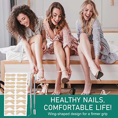 Ingrown Toenail Treatment, Ingrown Toenail Removal Kit With Pedicure Toenail Corrector Patch And Nail Correction Tool, Glue-Free And Painless Ingrown Toenail Corrector #TOP1