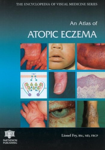 Atlas of Atopic Eczema (Encyclopedia of Visual Medicine Series Book 71) Atlas of Atopic Eczema (Encyclopedia of Visual Medicine Series Book 71)