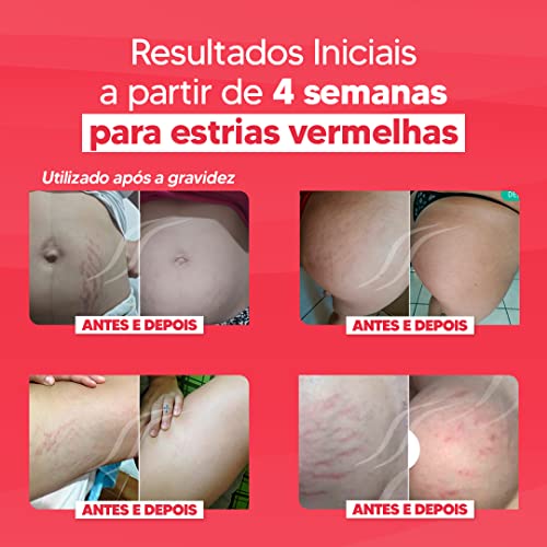 Cicatrissim Red Stretch Mark Removal Cream #TOP17