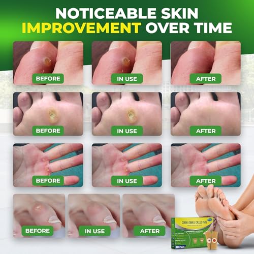 Image of Ulensy Corn Remover Pads for Feet Toes: 30-Pack Salicylic Acid Extra Strength Treatment - Fast Effective Medicated Bandages for Kids Adults Seniors Teens Athletes Runners Hikers Workers Men Women