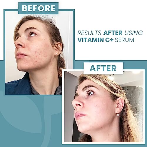 Vitamin C Serum For Face, Vitamin C Facial Serums For Anti Aging, Reduce Wrinkles & Dark Spots, Skin Brightening Serum, Face Serum With Hyaluronic Acid, Retinol, Niacinamide & Salicylic Acid (5Pc) #TOP7