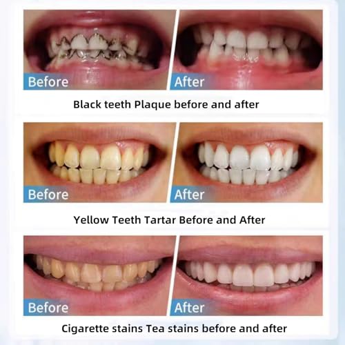 Image of Nano Physical Teeth Cleaning Stick, Teeth Whitening, Cleaning Teeth Smoke Stains, Tartar Stains, Home Oral Care Whitening Teeth Kit, 2+15 Pcs (with 2 Cotton Clips)