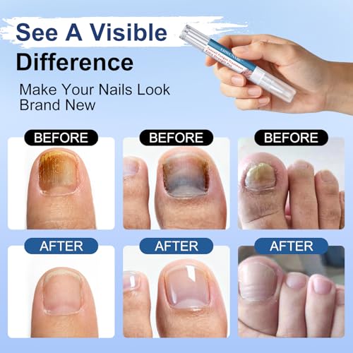 Image of Toenail Fungus Treatment Extra Strength, Fungi Nail Pen, 25% Undecylenic Acid, Ingrown toenail treatment, Repairs Yellow Thick Brittle Toe and foot fungus treatment extra strength - 9Pcs