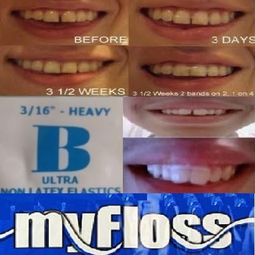 ORTHODONTIC GAP TEETH BANDS 3/16 HEAVY&FLOSS, 1 Pack of 100