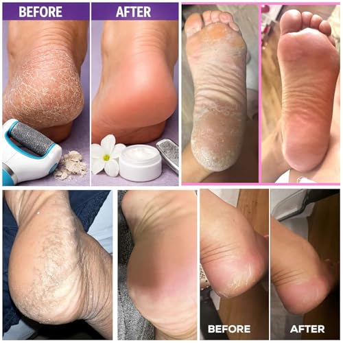 Image of Deep Cleansing Foot Mask for Dry Cracked Feet | FREE Natural Ginger & Bamboo Vinegar Patches for Toxin Removal, Pain Relief, Better Sleep & Circulation for Men & Women | (Foot Mask & Foot Soak)