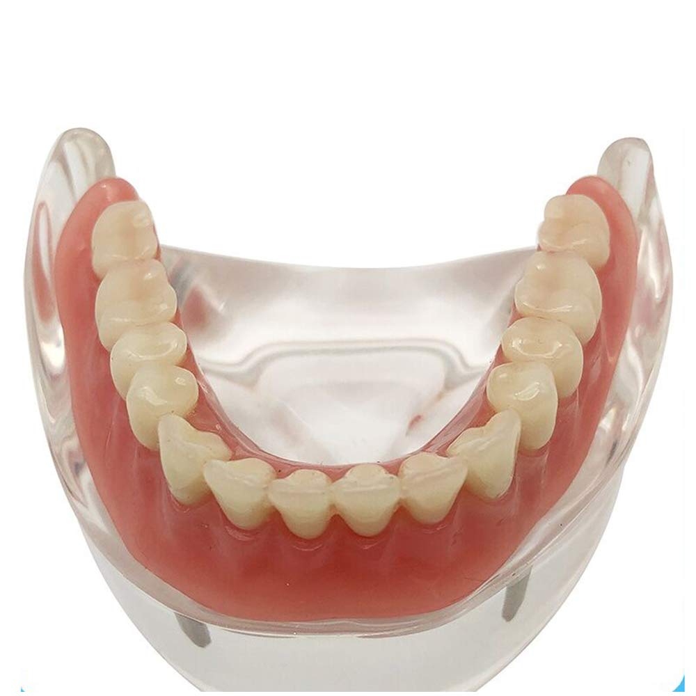 Sjdopulse A Teeth Implant Model - Dental Teeth Study Teaching Model - Dental Teeth Study Teaching Model With 2 Implants Overdenture Inferior Study Nalysis Demonstration Model (A)