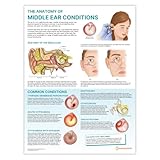 Poster "The Anatomy of Middle Ear Conditions", 45 x 60 cm, HNO-Lernwerkzeug, anatomisches Wanddiagramm