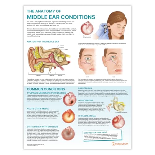 Póster de la anatomía de las condiciones del oído medio, 45 x 60 cm, herramienta de aprendizaje ORL, diagrama anatómico de pared