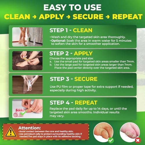 image for Ulensy Corn Remover Pads for Feet Toes: 30 Pack 40% Salicylic Acid Ext